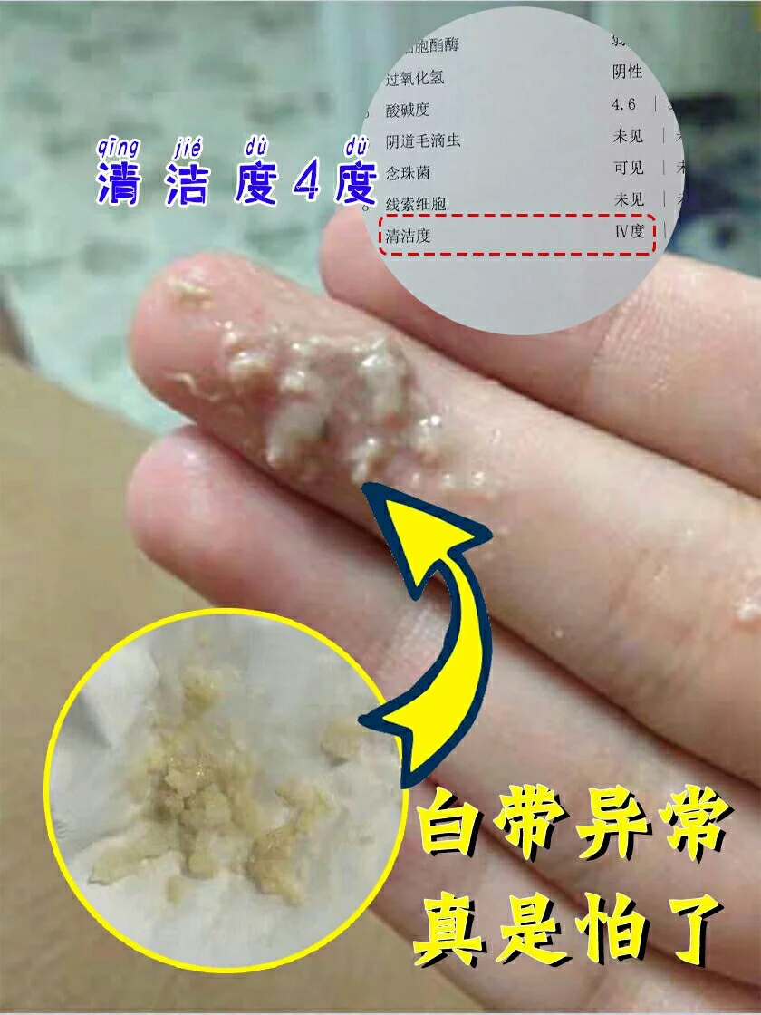 白带豆腐渣能用手抠出来吗
