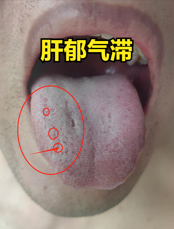 肝火旺的症状表现