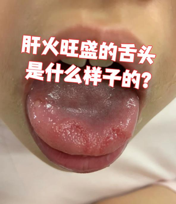 肝火旺的症状表现