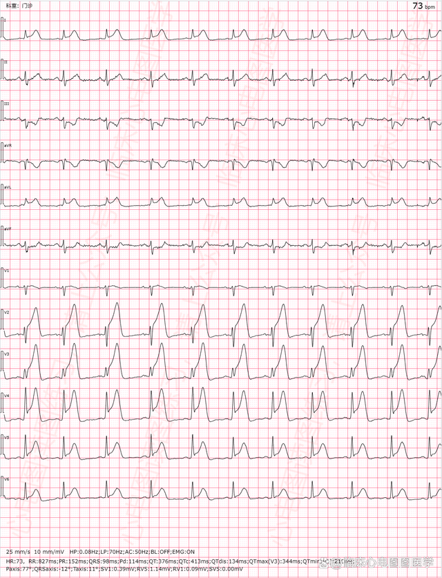t波改变能恢复吗