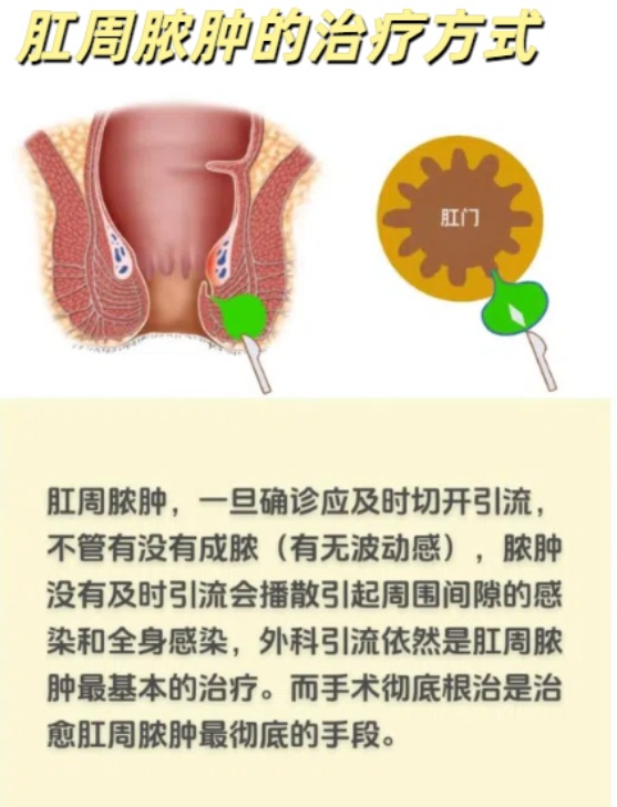 肛周囊肿一定要开刀吗?怎么治?