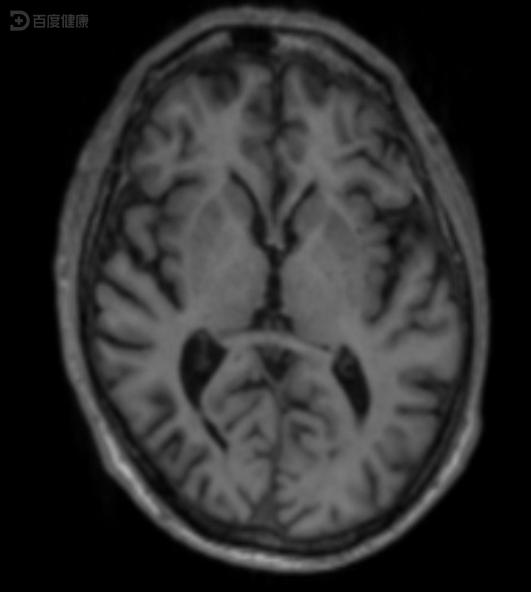 失忆症的临床症状