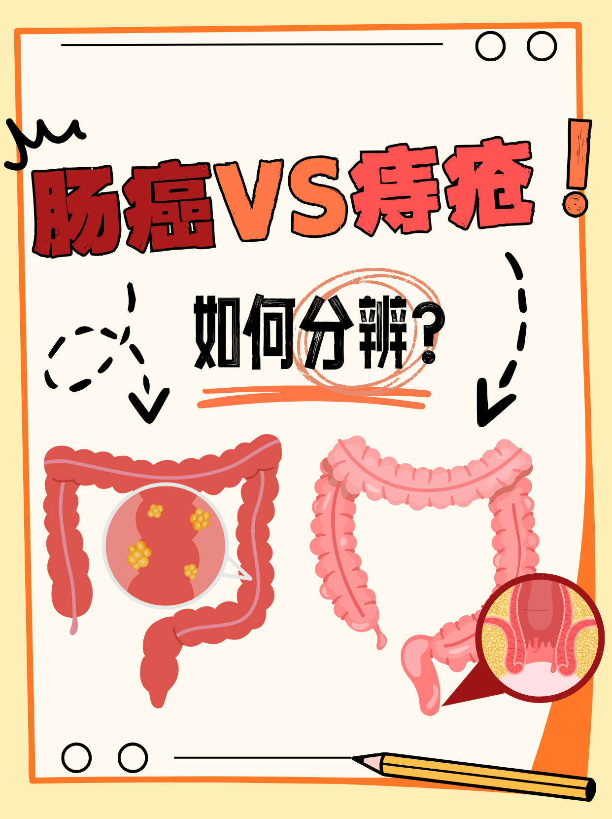 内痔与外痔的区别