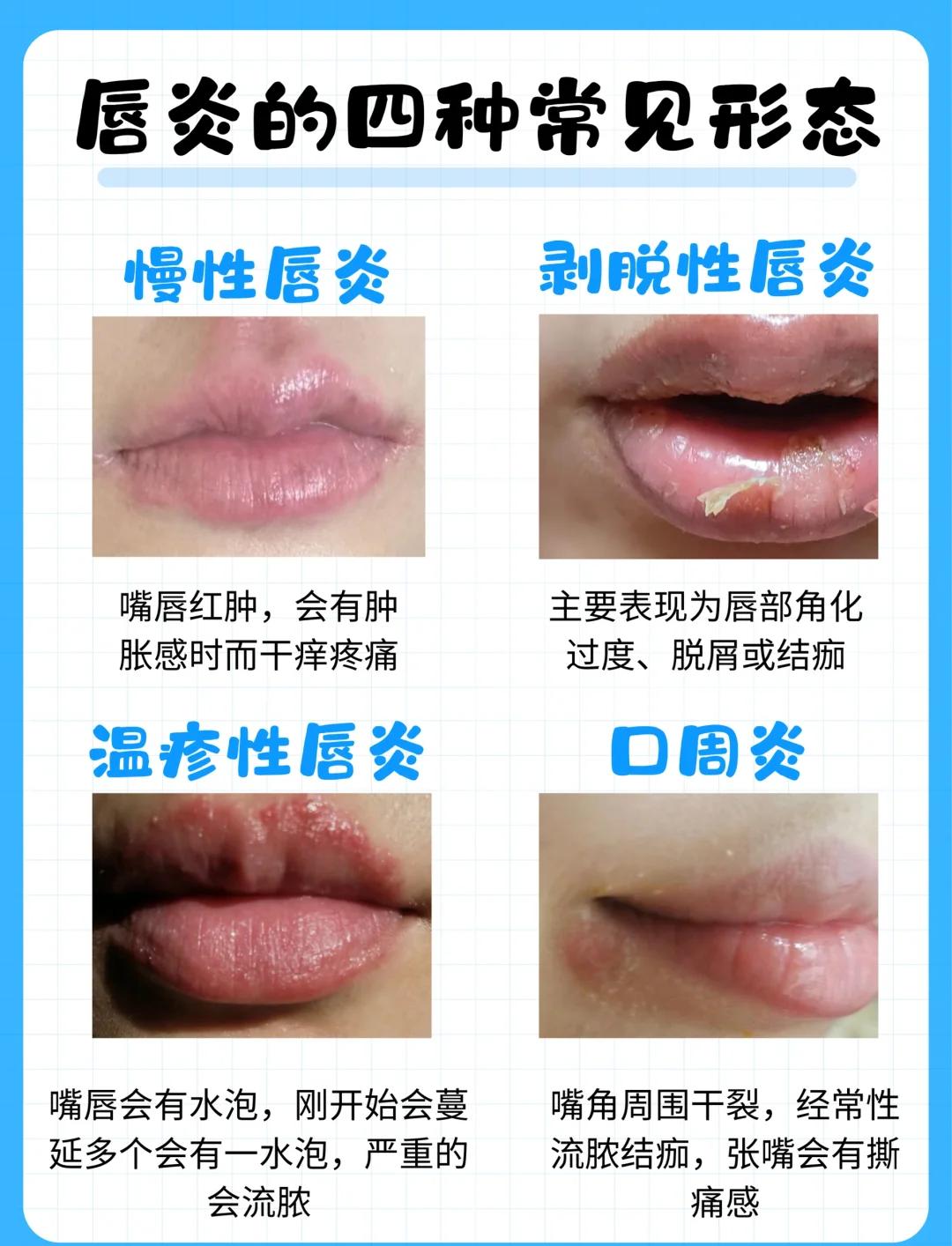 上嘴唇发麻是什么原因