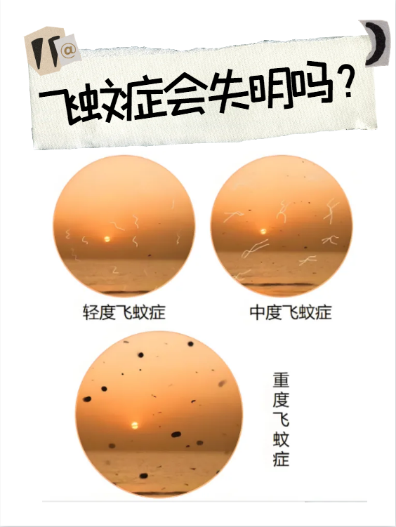 飞蚊症是如何引起的
