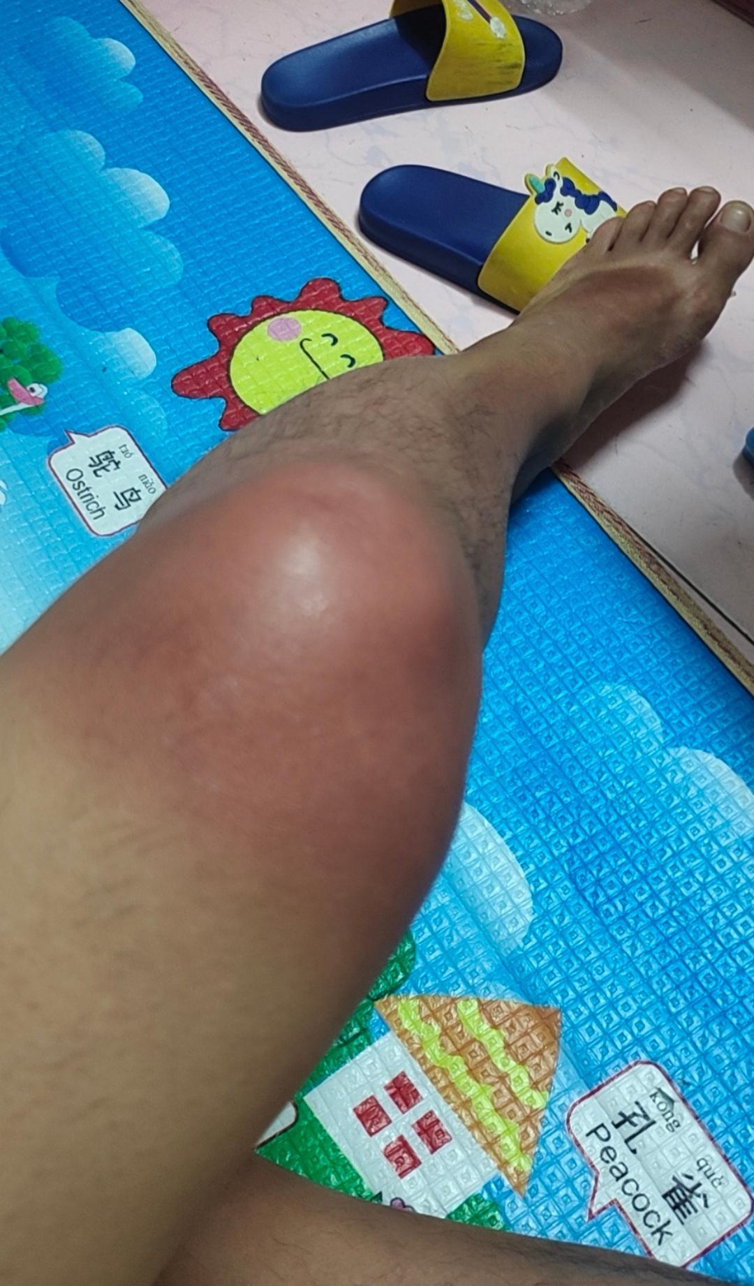 小腿水肿是怎么回事?