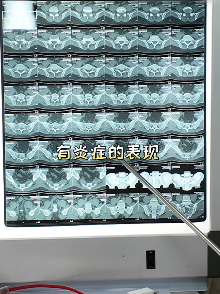 强直性脊柱炎初期症状?