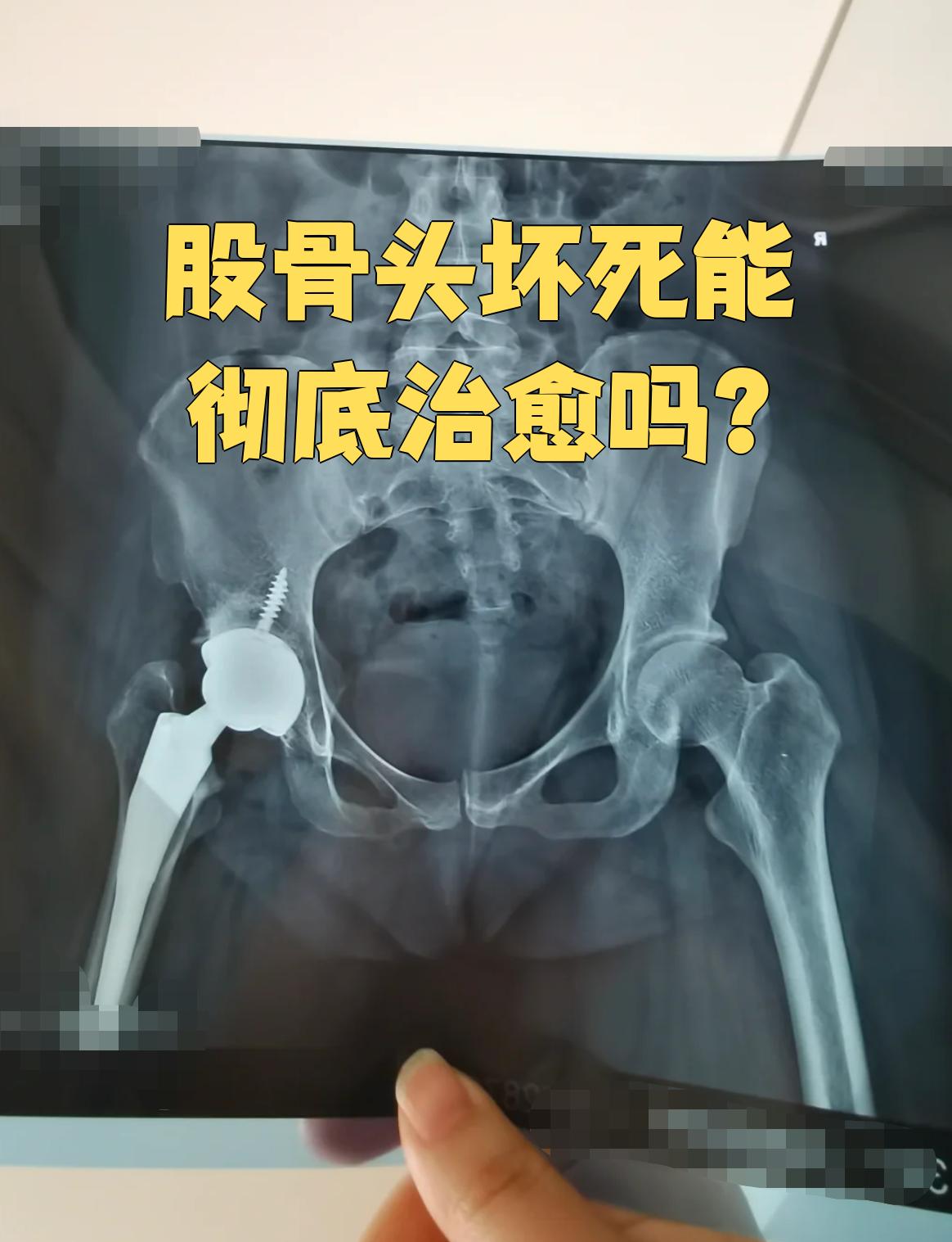 股骨头坏死可能治好吗