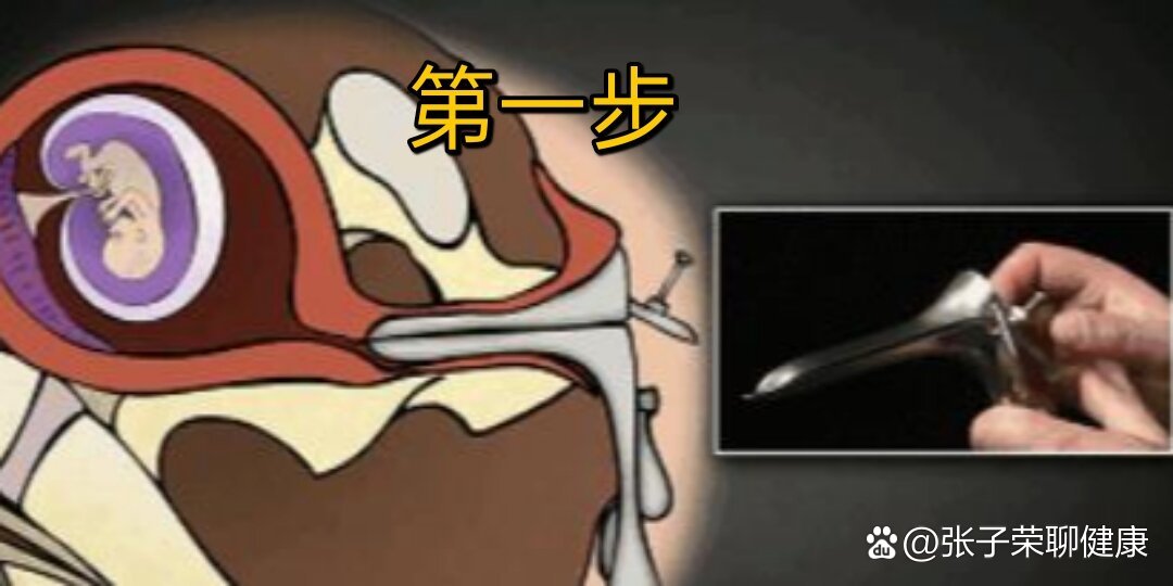 无痛人流的过程是什么?