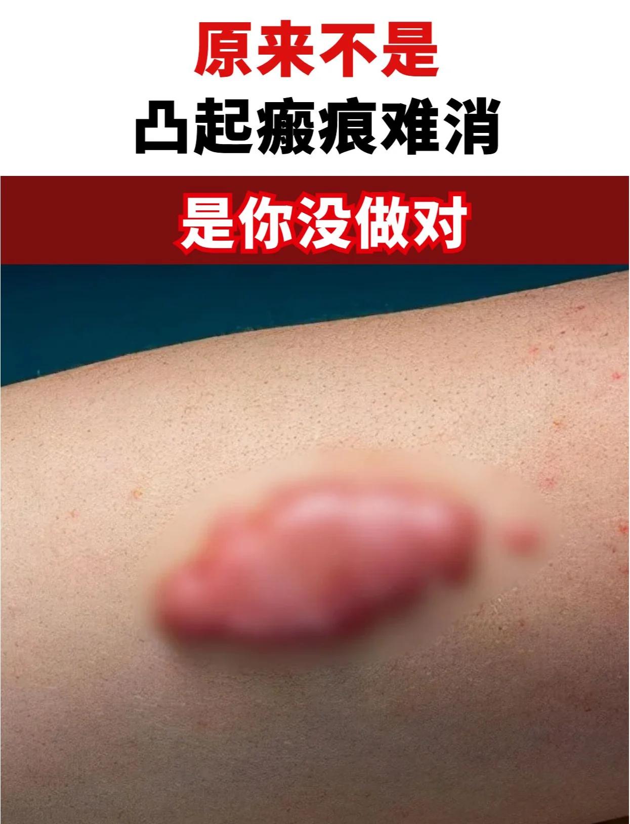 疤痕增生多久可以变平