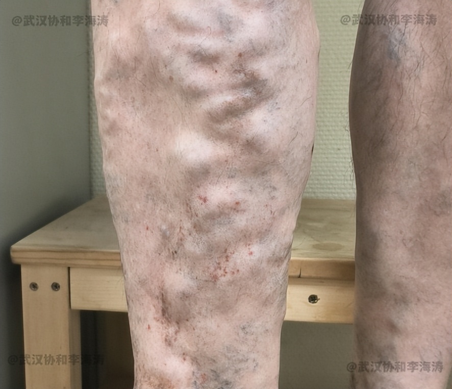 静脉曲张的症状有哪些