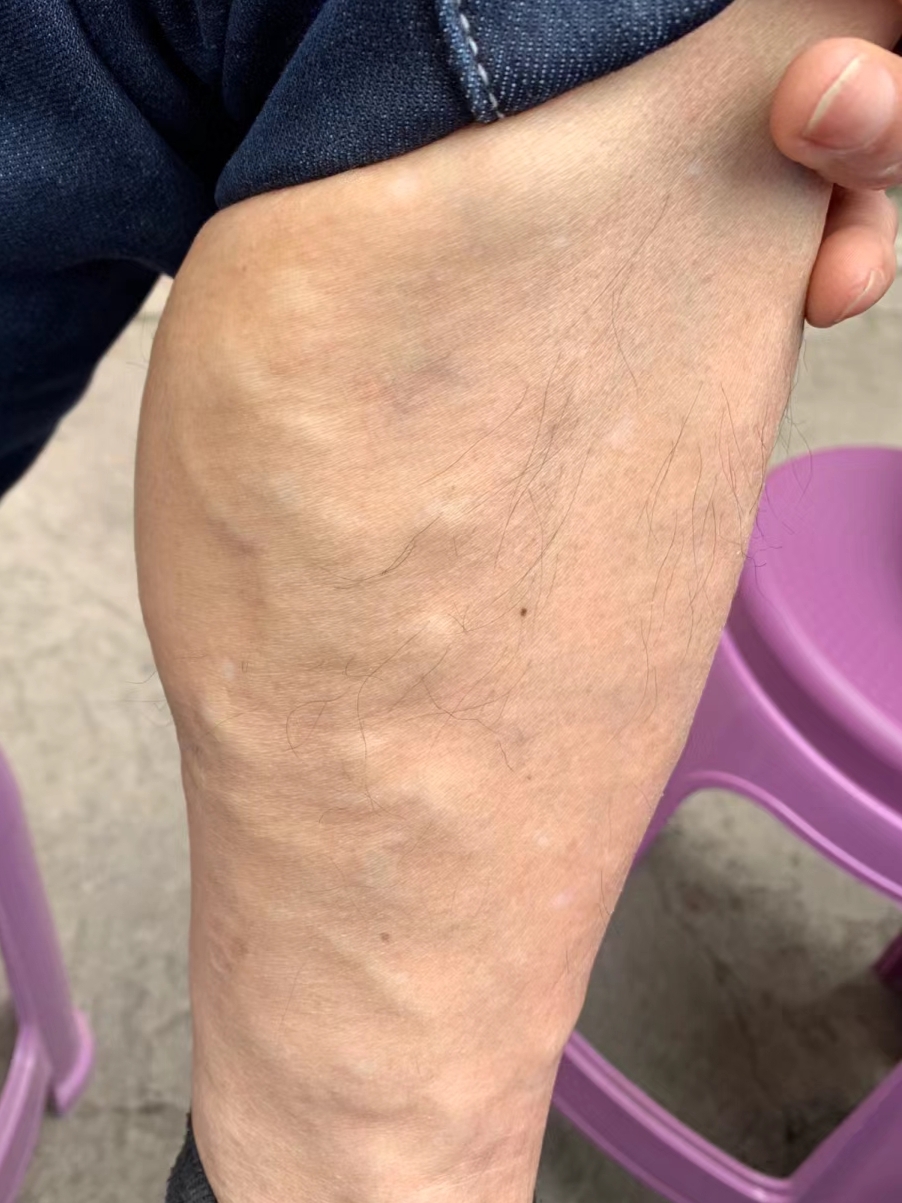 静脉曲张的症状有哪些