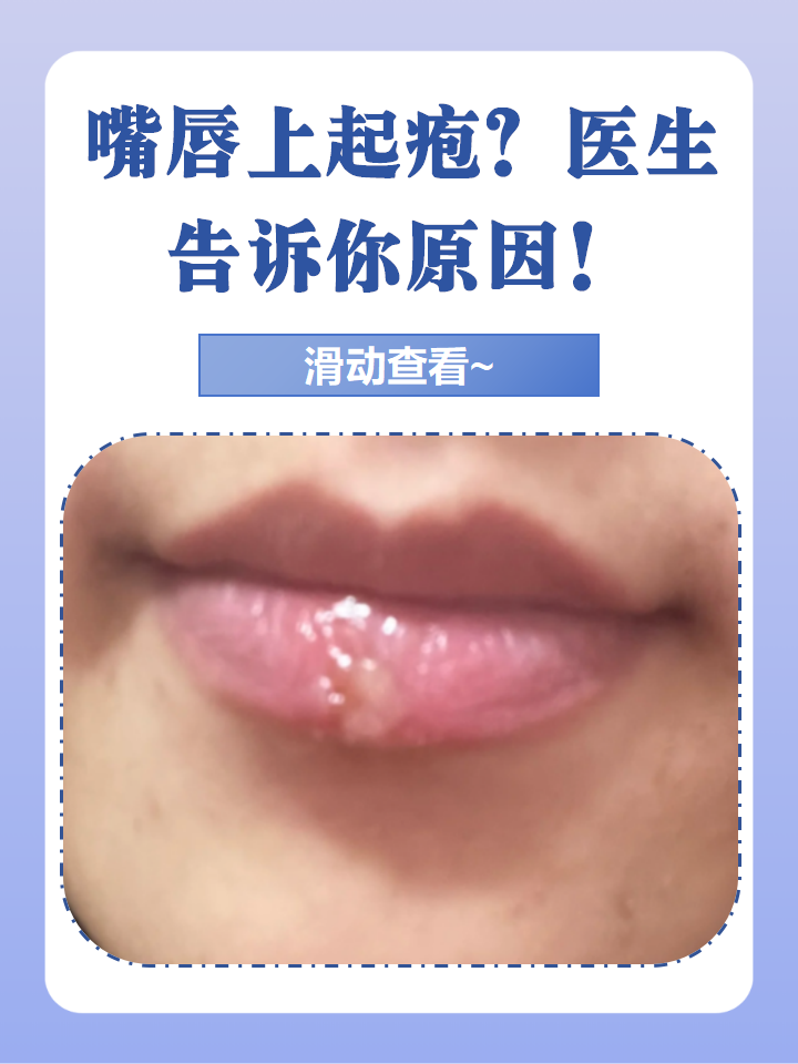 嘴巴周围反复长痘痘怎么回事