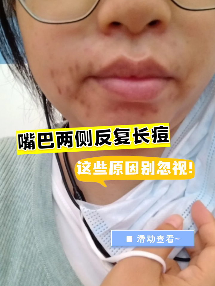 嘴巴周围反复长痘痘怎么回事