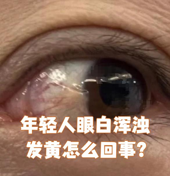 眼白浑浊发黄怎么回事啊