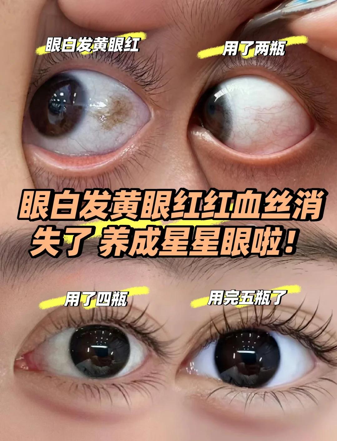 眼白浑浊发黄怎么回事啊