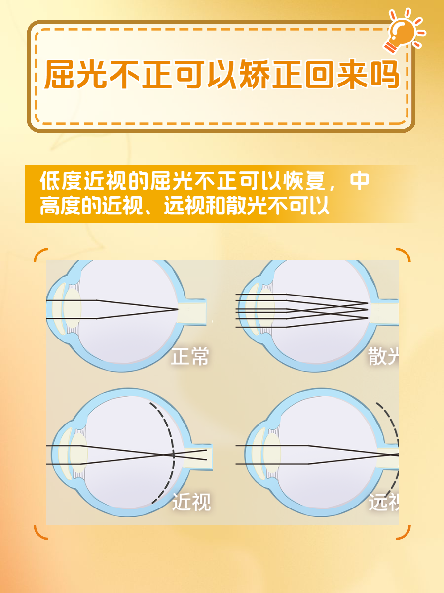 400度近视如何自己恢复.