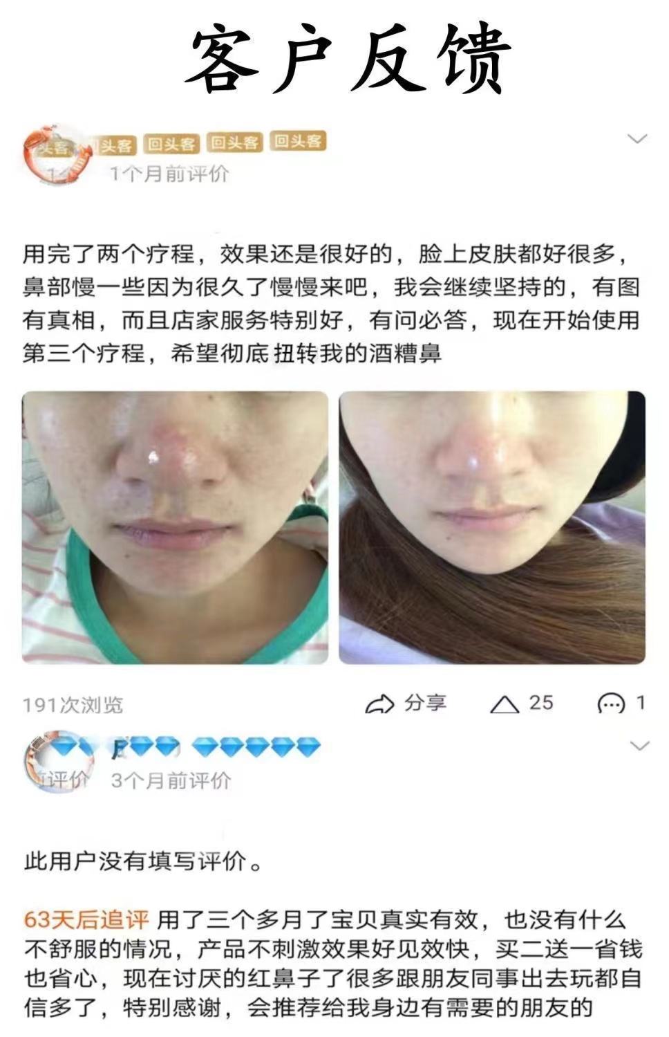 酒糟鼻怎么根治