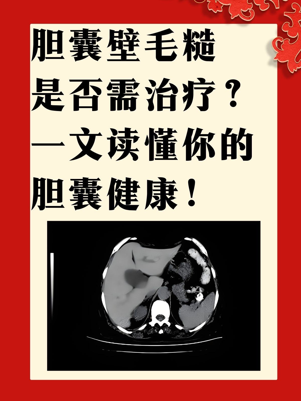 胆囊壁毛糙是什么原因