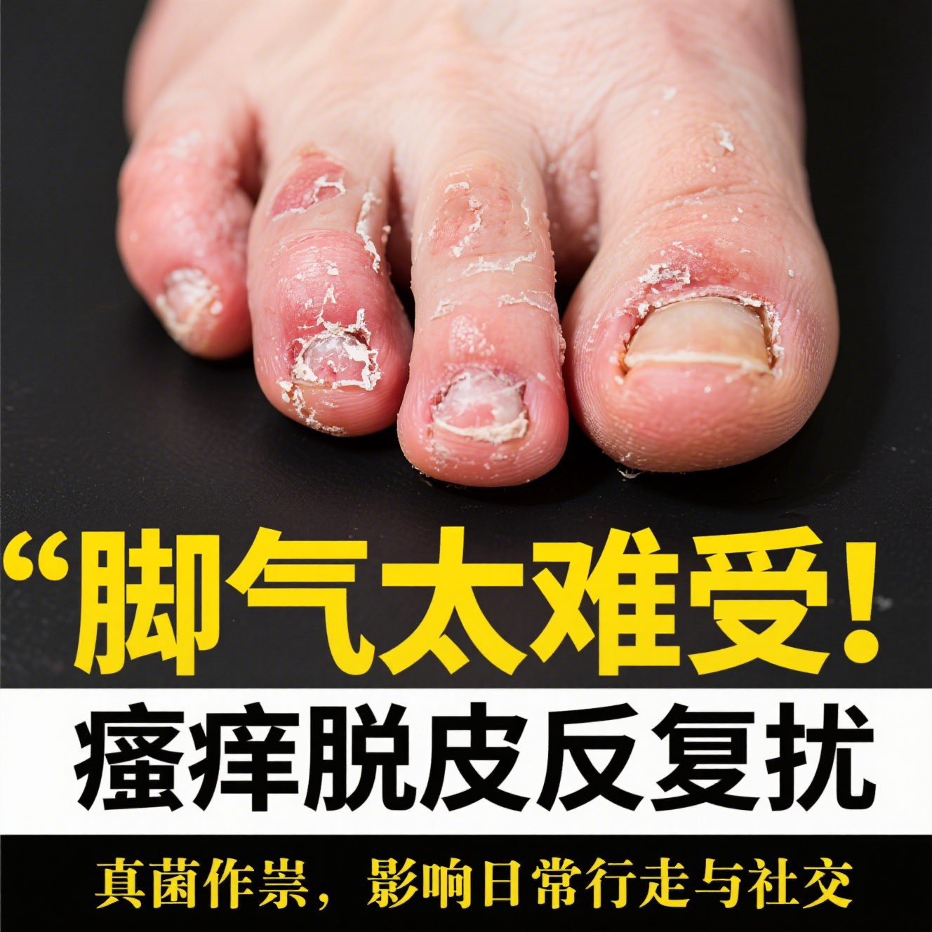 手足癣是怎么引起的