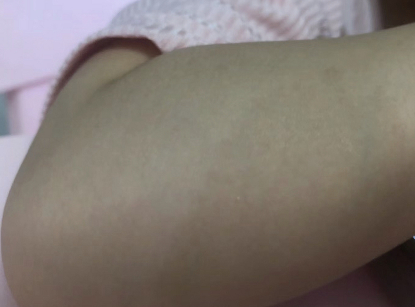 身上有褐色斑点,不疼不痒