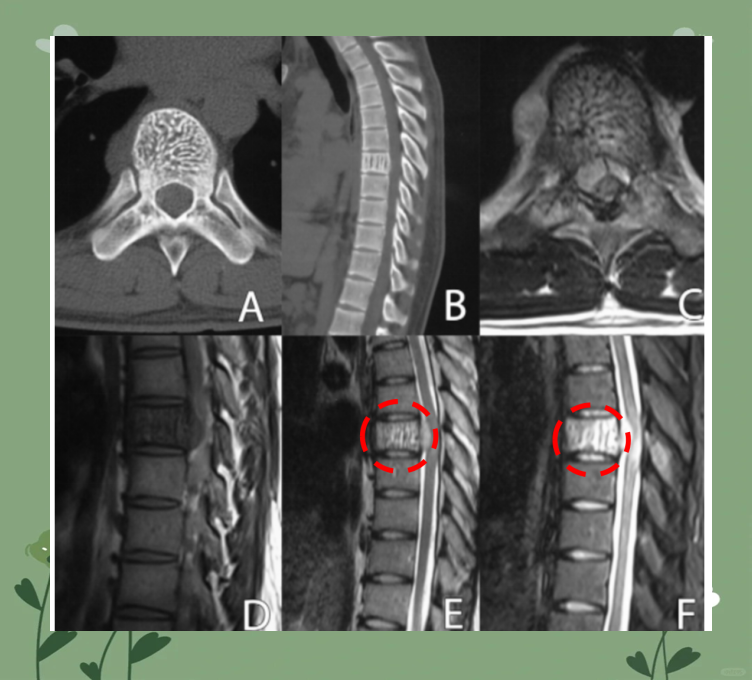 腰椎肿瘤是怎么回事?