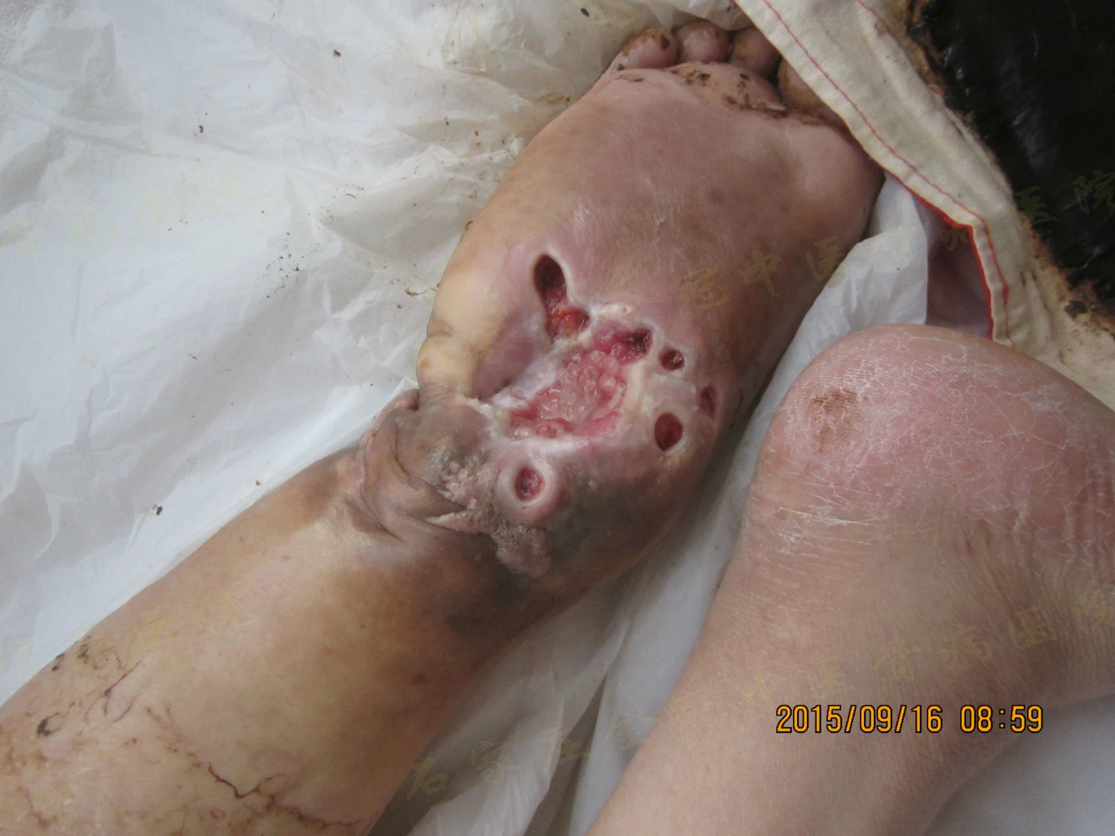 什么是化脓性的骨髓炎