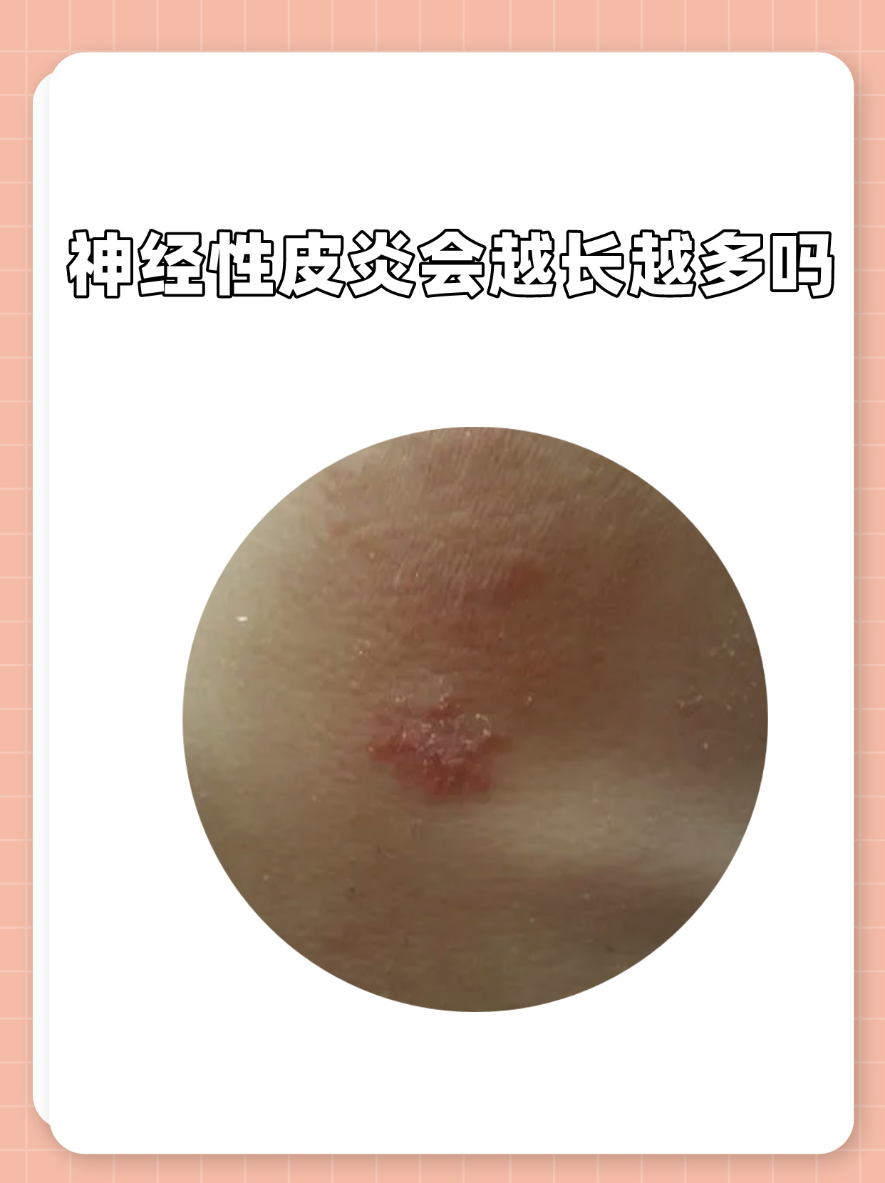 什么是周围神经炎