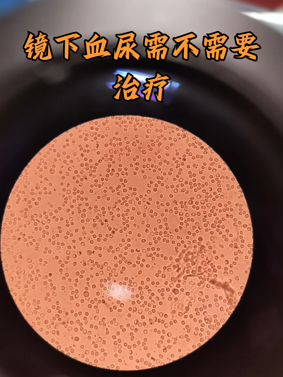 尿液中红细胞高是怎么回事