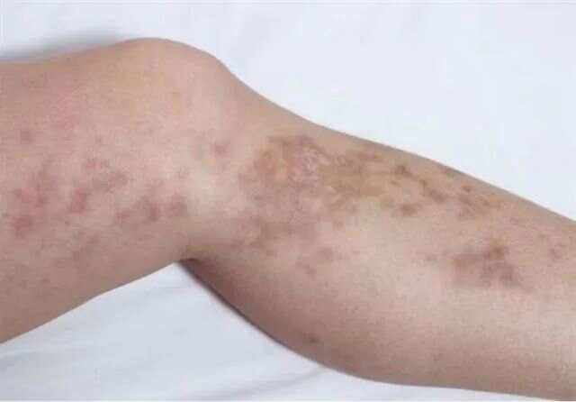 年轻人糖尿病初期表现