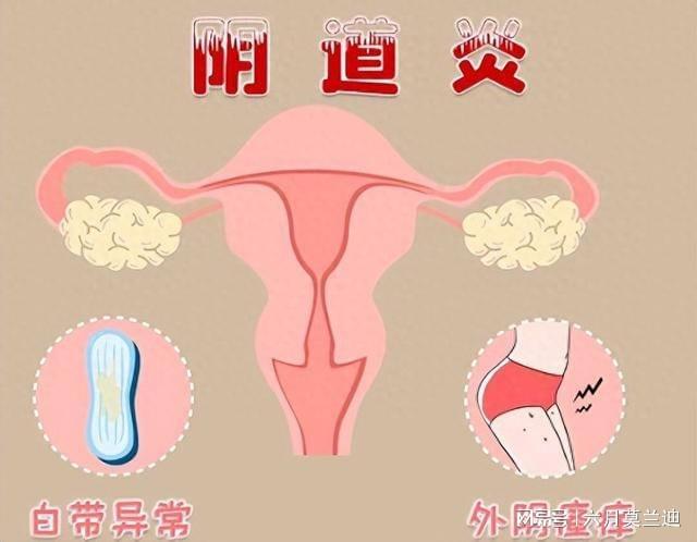 什么是细菌性阴道病?