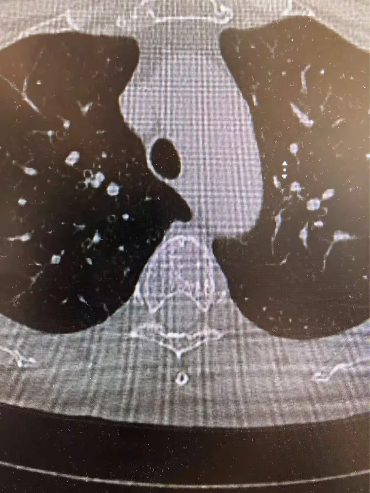 乳腺癌术后骨转移活多久