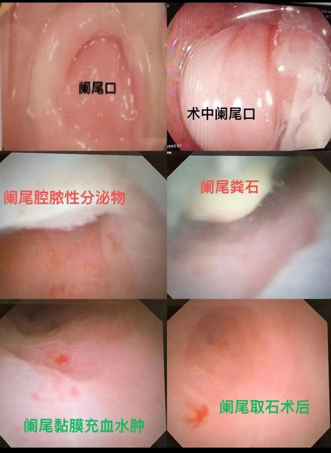 阑尾炎可以微创手术吗