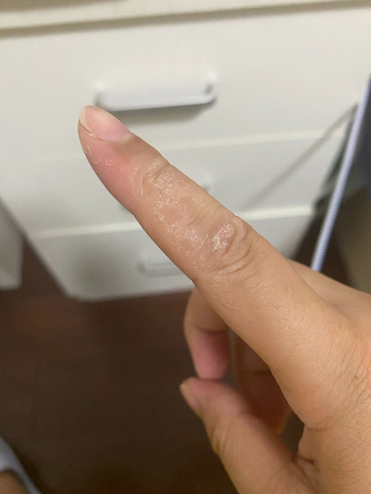 手指肚脱皮是怎么回事