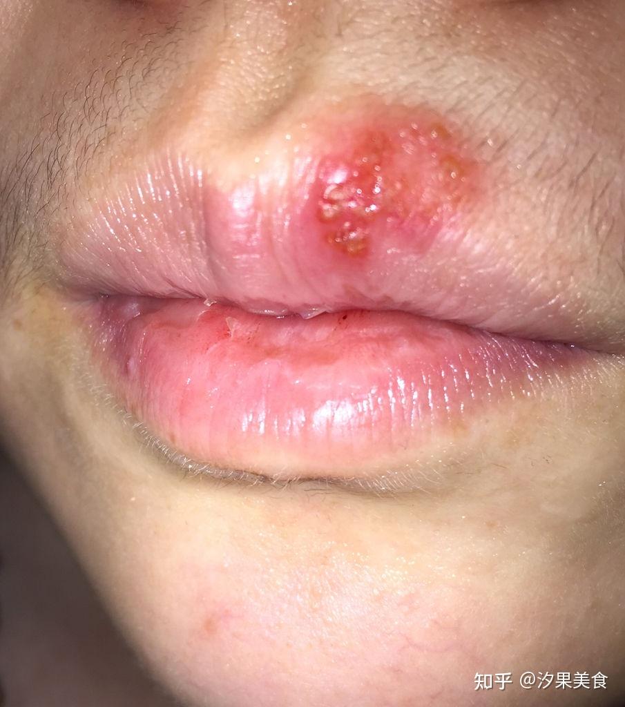 嘴唇上长了很多小泡泡