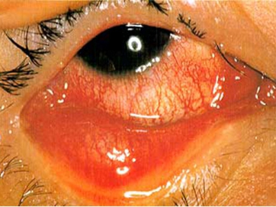 过敏性结膜炎有什么症状