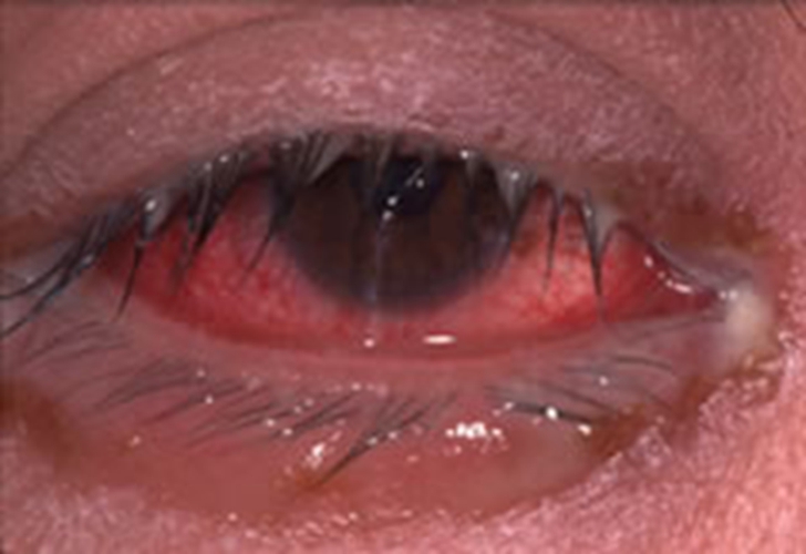 过敏性结膜炎有什么症状