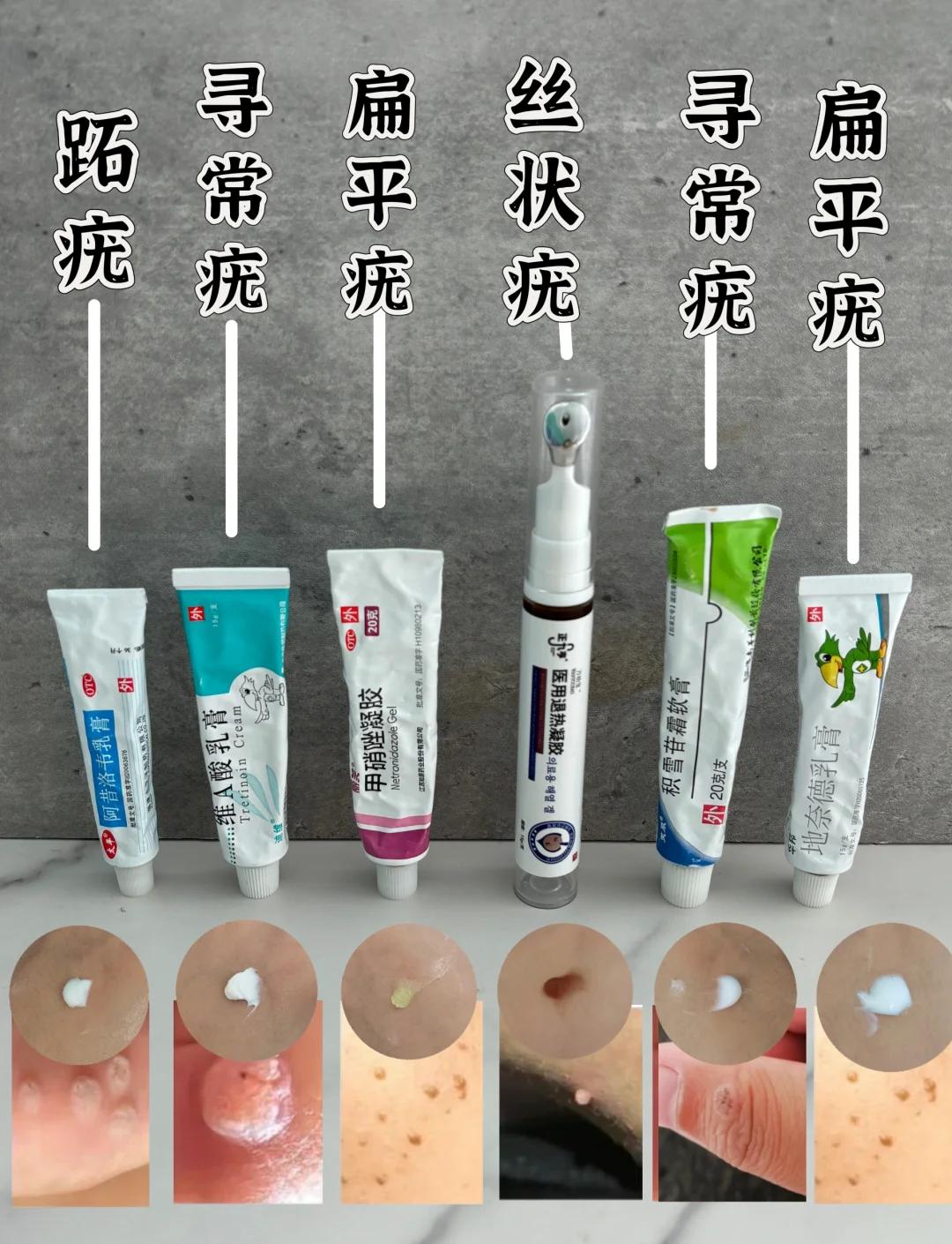 尖锐湿疣有什么外用药