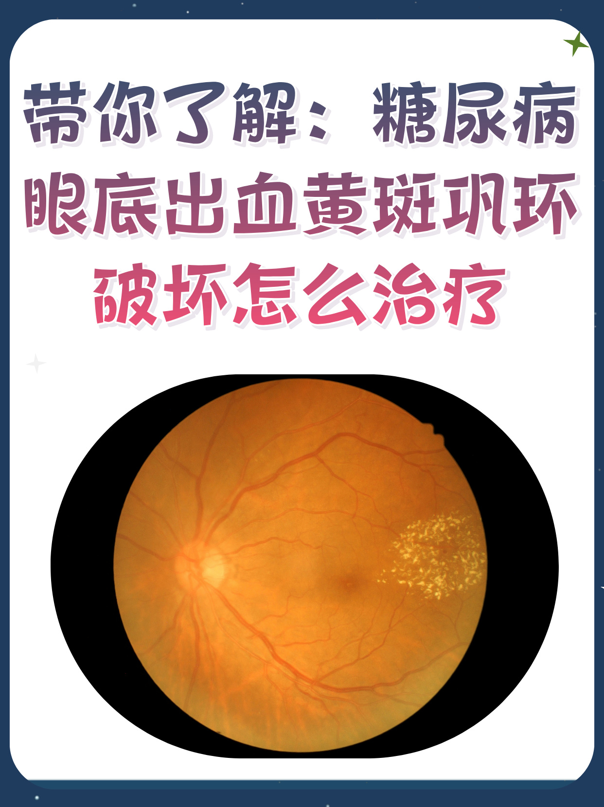 眼底出血是什么原因引起的