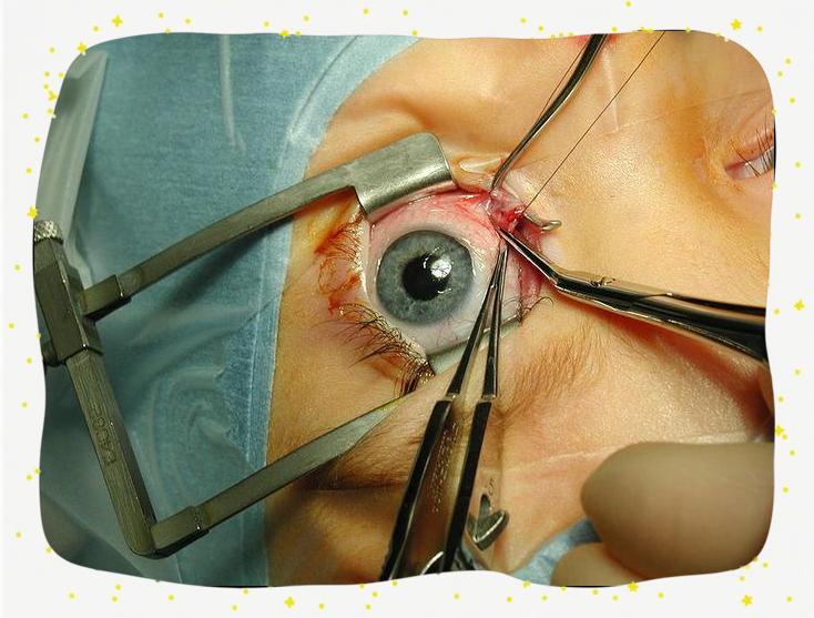 做斜视手术时会有痛苦吗