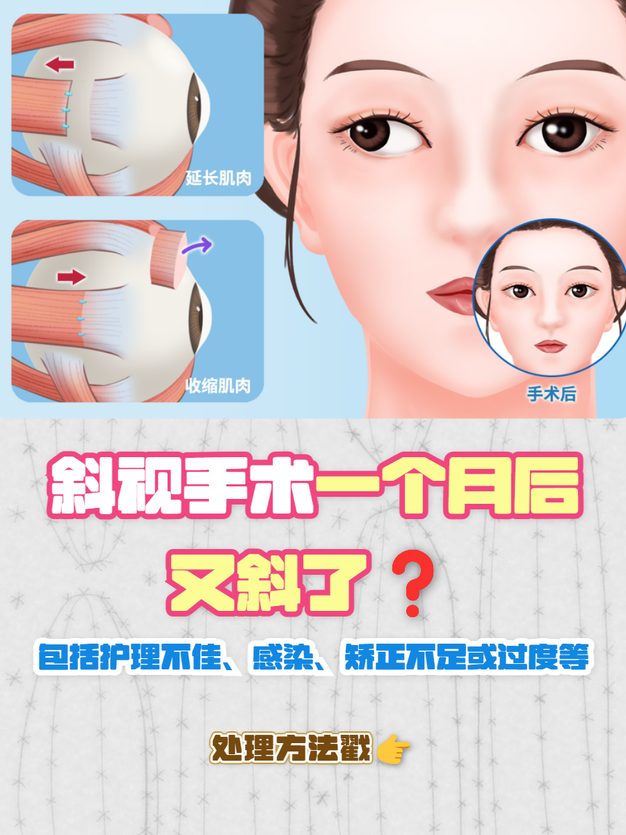 做斜视手术时会有痛苦吗