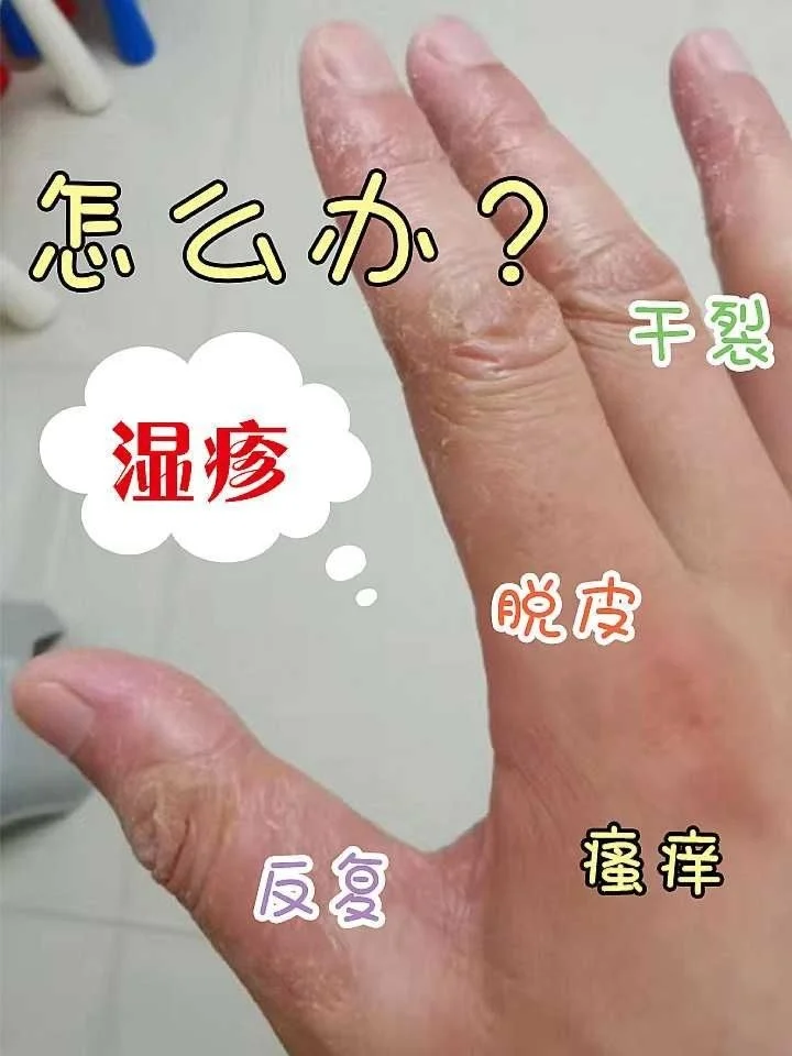 十滴水治疗湿疹吗