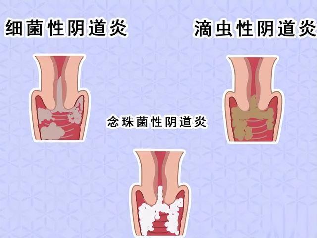 霉菌性阴道炎会影响怀孕吗