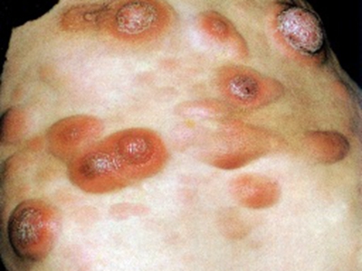 白血病的症状有哪些