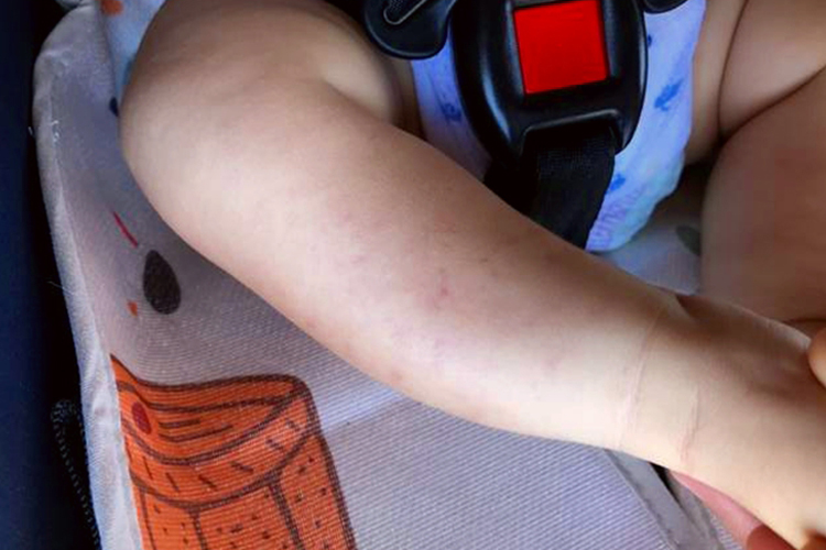 白血病的症状有哪些