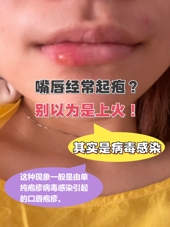 嘴唇长疱疹怎么好得快