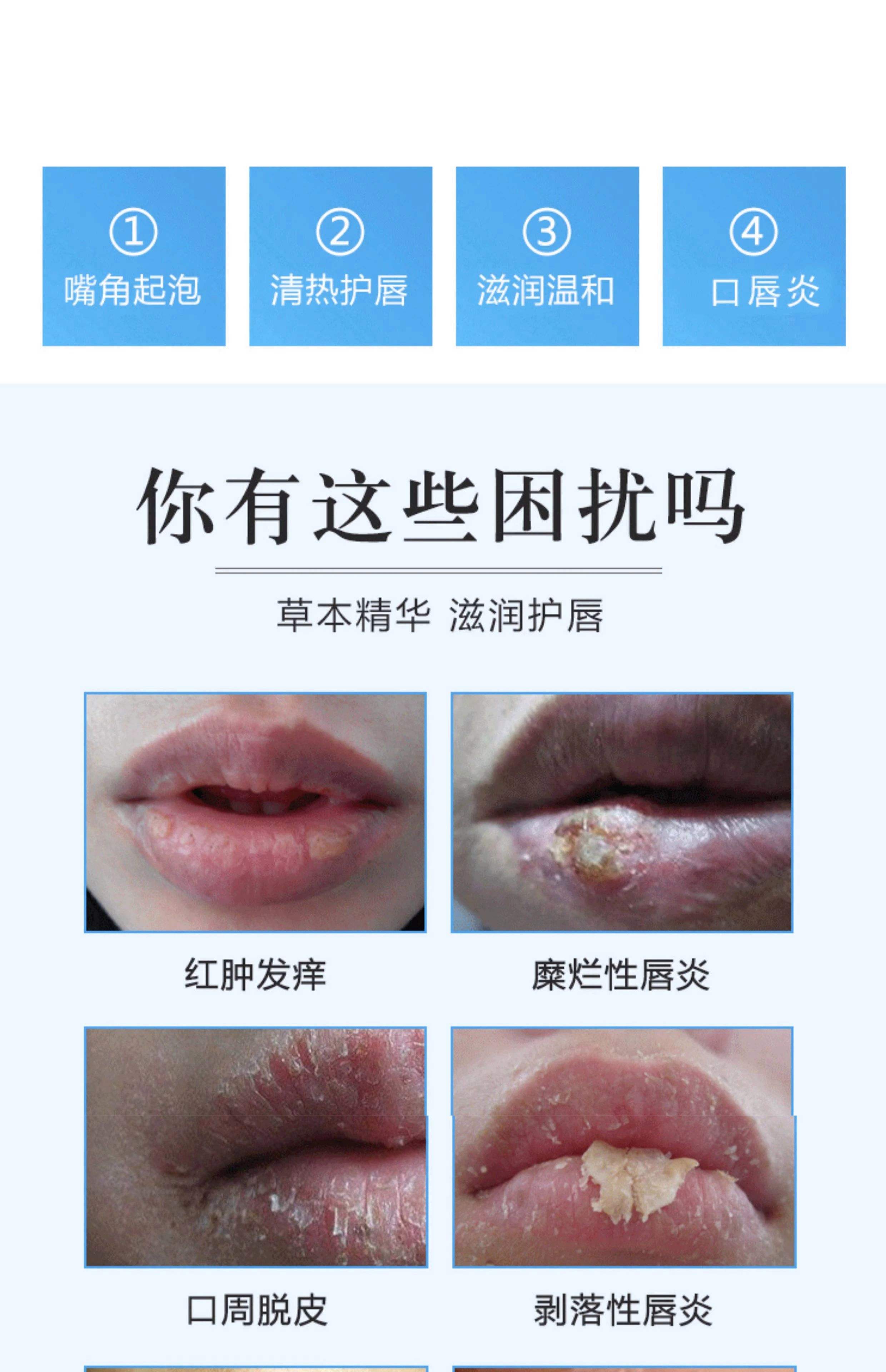 嘴唇长疱疹怎么好得快