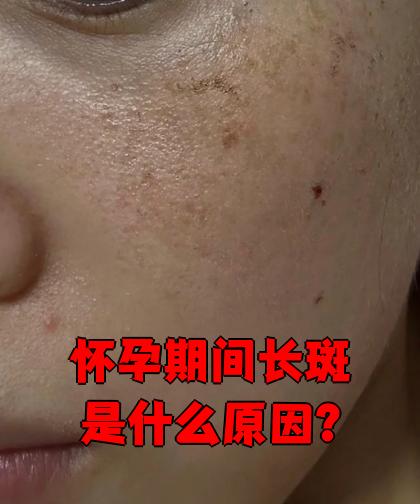 怀孕了脸上长斑怎么办?