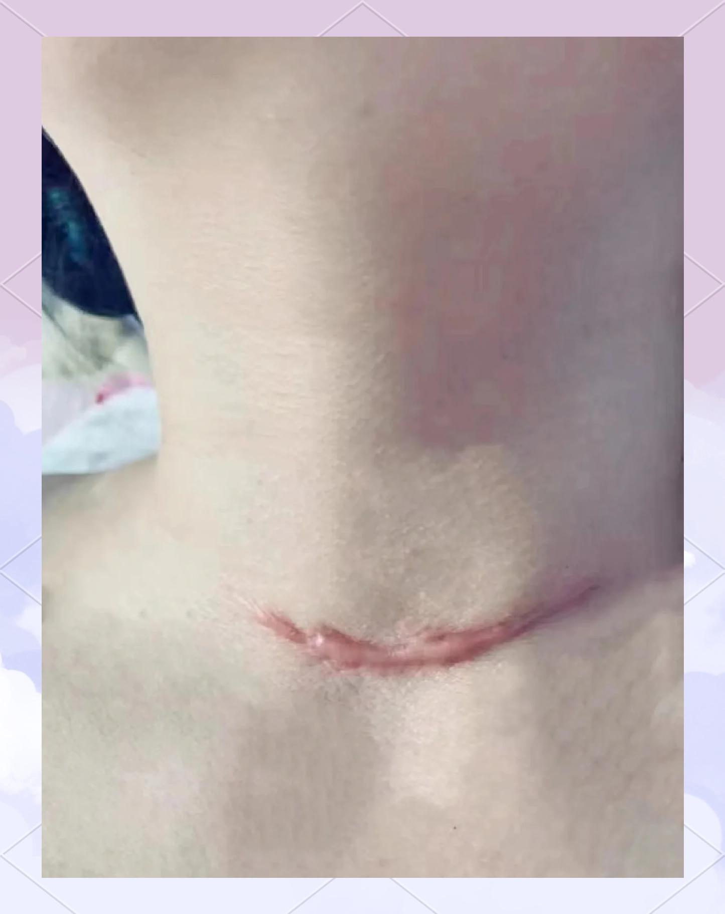 甲状腺手术后遗症