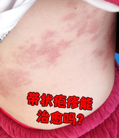 带状疱疹的表现症状是什么